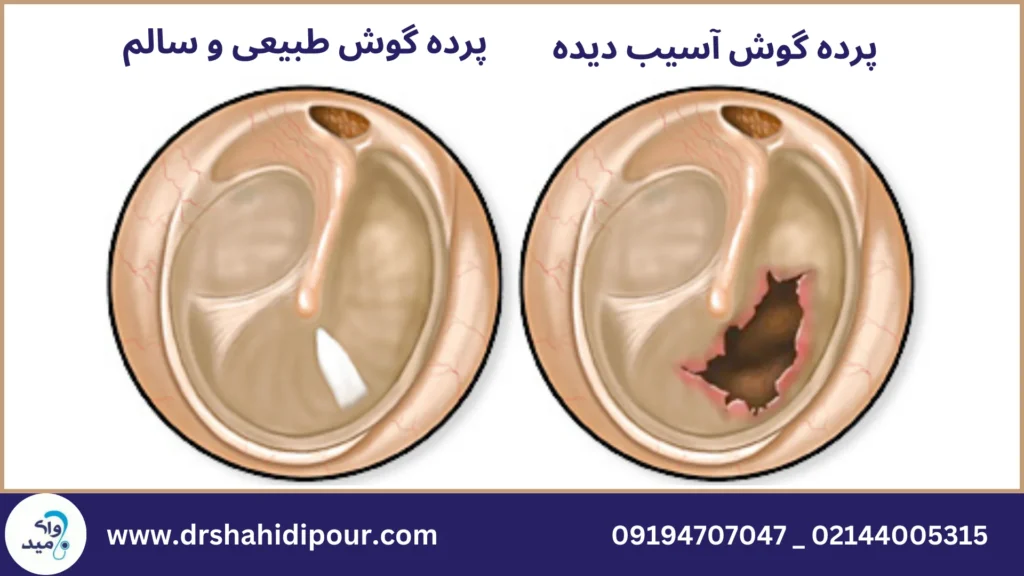 پرده گوش آسیب دیده